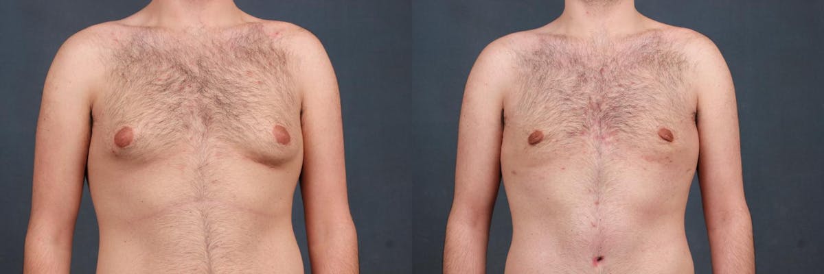 Male Reduction Before & After Gallery - Patient 331066 - Image 1