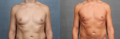Male Breast Reduction Before & After Gallery - Patient 990068 - Image 1