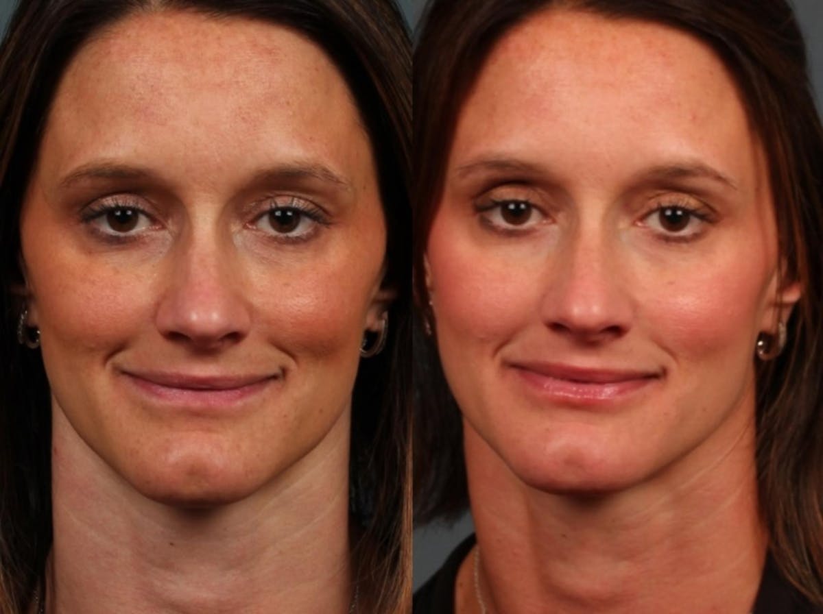 Advanced Medical Facials Before & After Gallery - Patient 132235 - Image 1