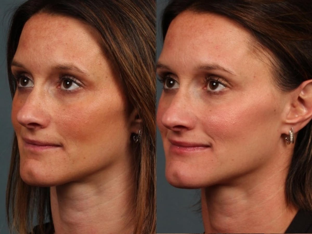 Advanced Medical Facials Before & After Gallery - Patient 132235 - Image 2