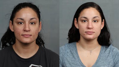 Advanced Medical Facials Before & After Gallery - Patient 358027 - Image 1