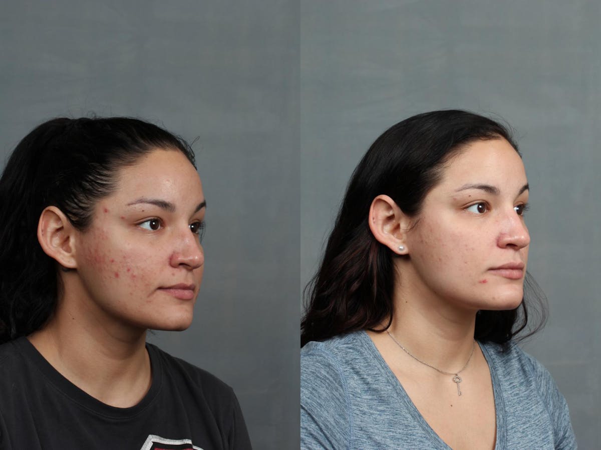 Advanced Medical Facials Before & After Gallery - Patient 358027 - Image 3