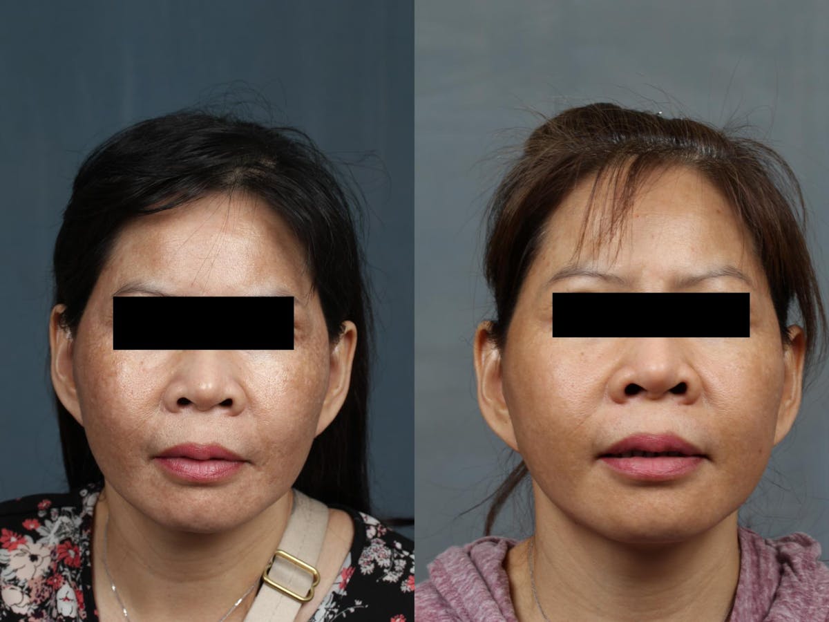 Advanced Medical Facials Before & After Gallery - Patient 374165 - Image 1