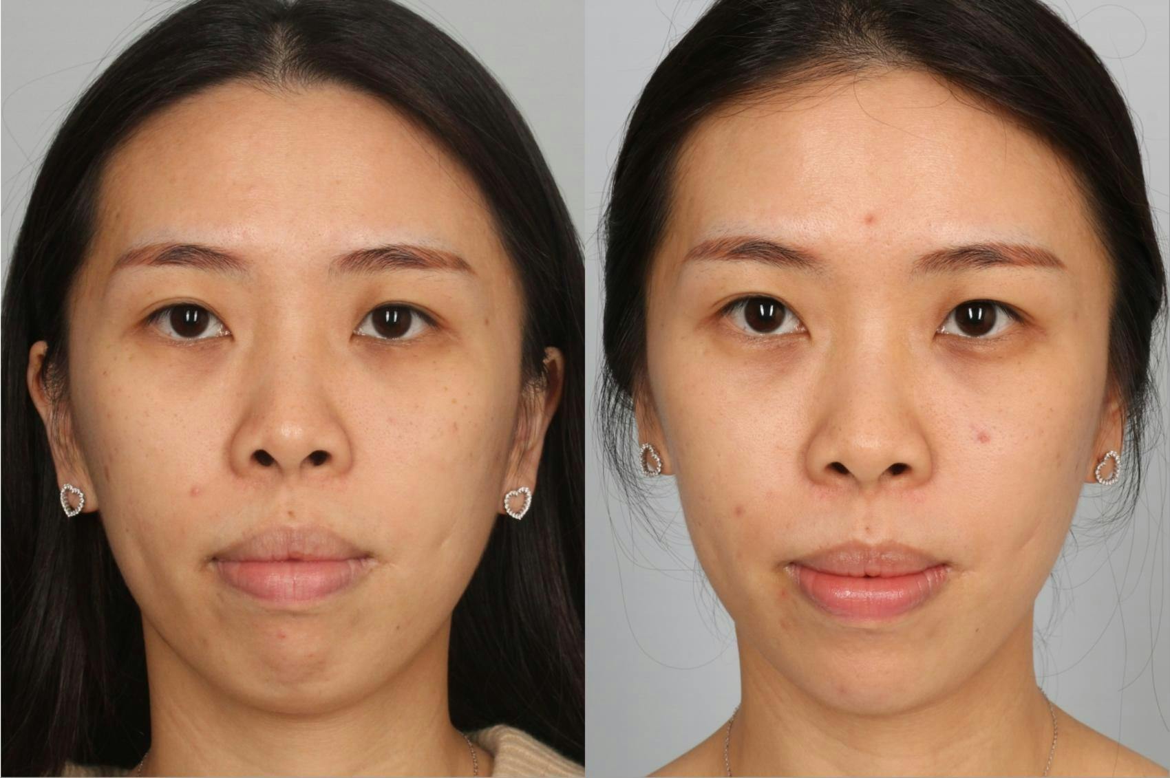 Dermal Fillers Before & After Gallery - Patient 105165 - Image 1