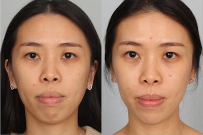 Dermal Fillers Before & After Gallery - Patient 105165 - Image 1