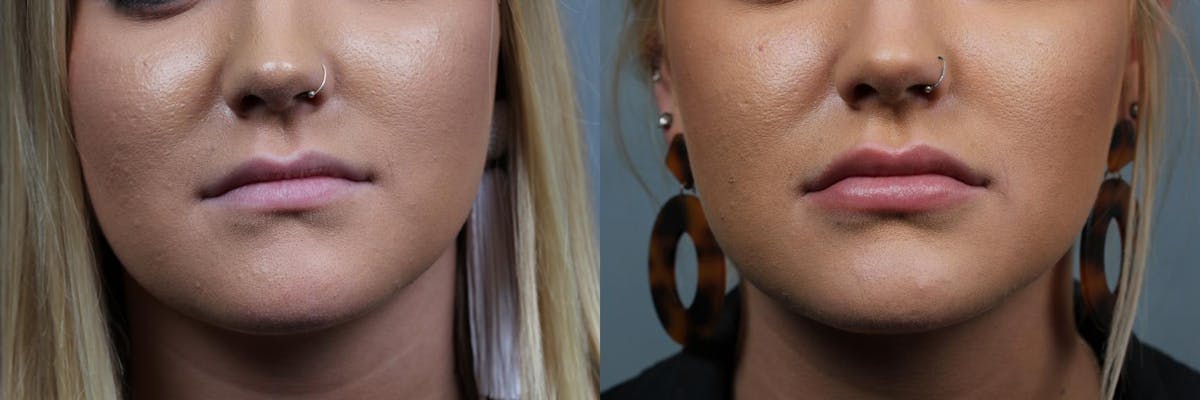 Lip Fillers Before & After Gallery - Patient 168566 - Image 1