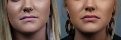 Dermal Fillers Before & After Gallery - Patient 305170 - Image 1