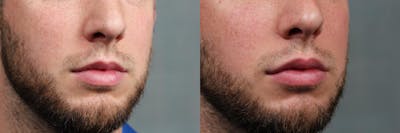 Dermal Fillers Before & After Gallery - Patient 782651 - Image 1