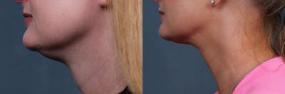 KYBELLA Before & After Gallery - Patient 272904 - Image 1