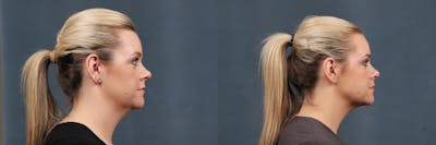 KYBELLA Before & After Gallery - Patient 310475 - Image 1