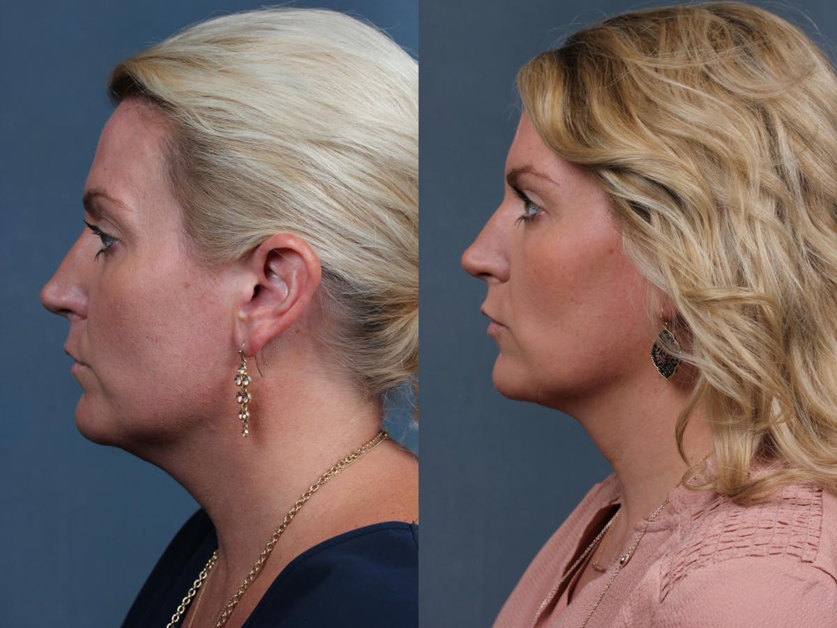 KYBELLA Before & After Gallery - Patient 403297 - Image 1