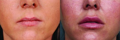 Lip Fillers Before & After Gallery - Patient 263611 - Image 1