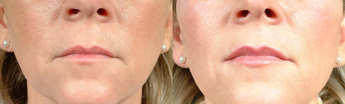 Lip Injections Before & After Gallery - Patient 295135 - Image 1