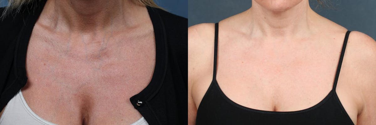 Excel V Laser Treatment Before & After Gallery - Patient 100493 - Image 1