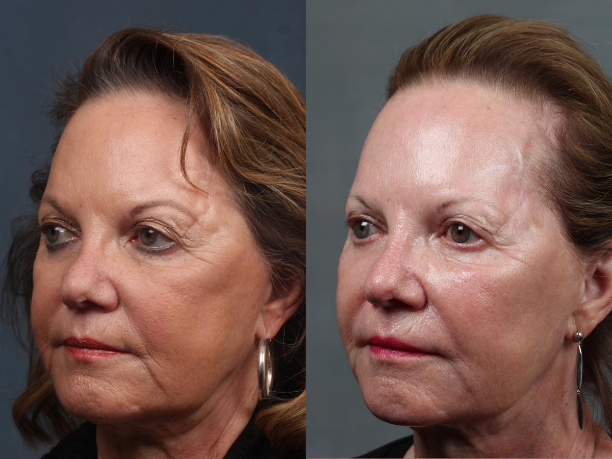 Excel V Laser Treatment Before & After Gallery - Patient 212686 - Image 2