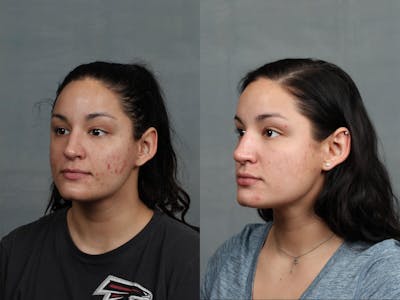 Excel V Laser Treatment Before & After Gallery - Patient 167501 - Image 1