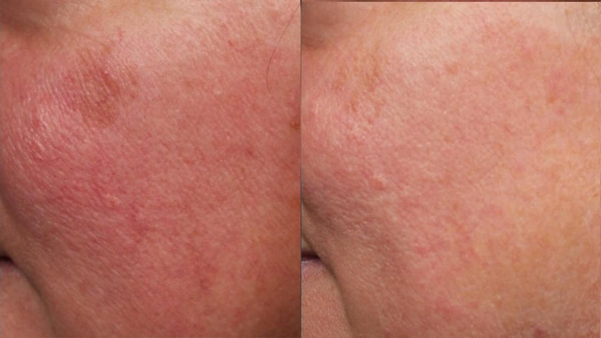 Excel V Laser Treatment Before & After Gallery - Patient 518997 - Image 2