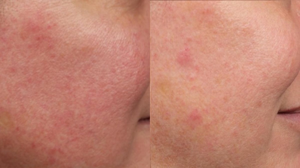 Excel V Laser Treatment Before & After Gallery - Patient 518997 - Image 3