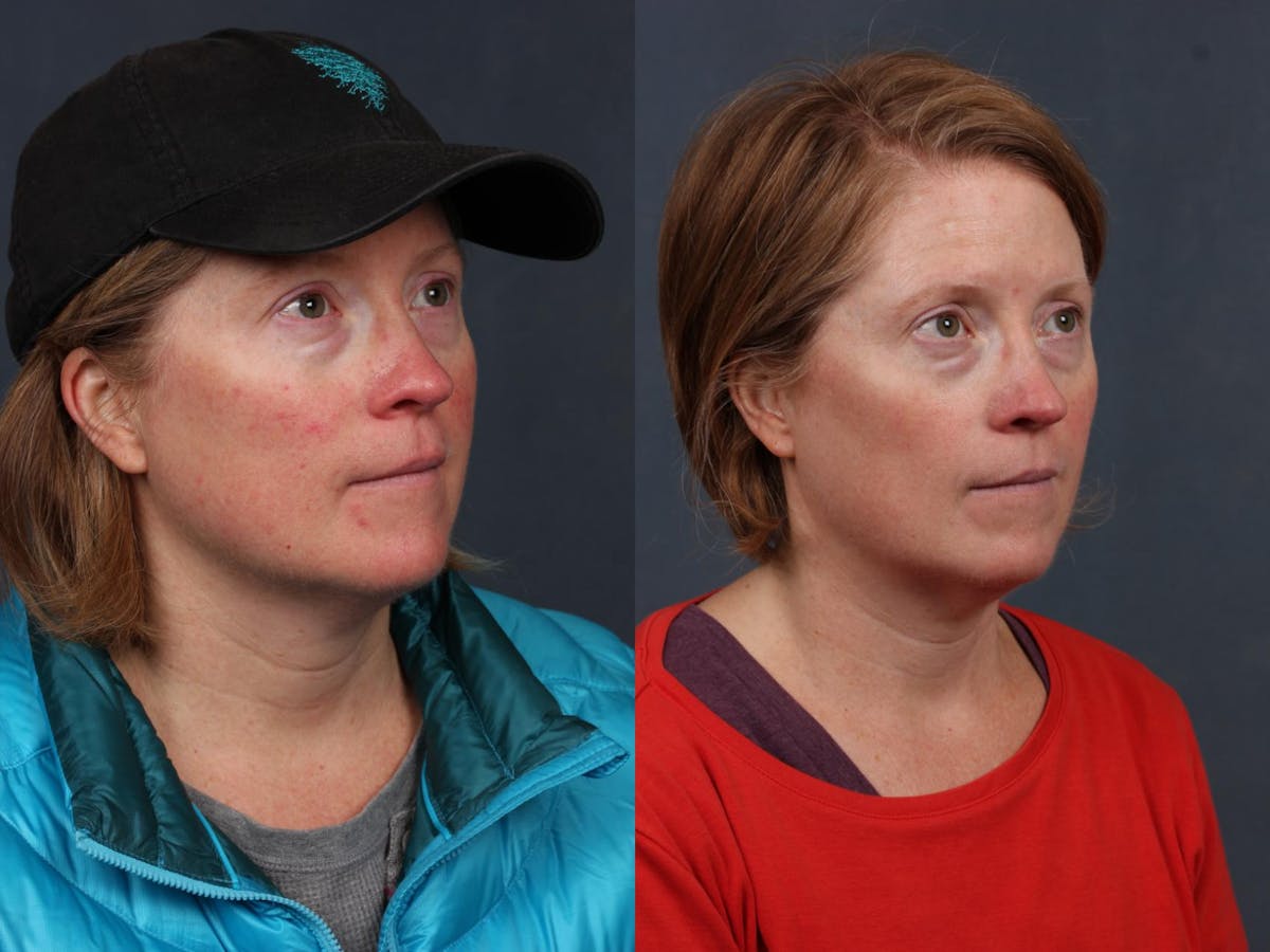 Excel V Laser Treatment Before & After Gallery - Patient 365697 - Image 2