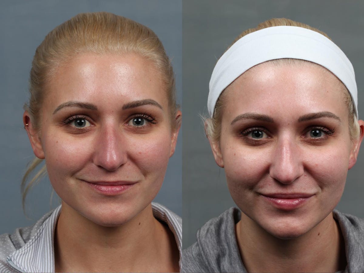 Excel V Laser Treatment Before & After Gallery - Patient 237993 - Image 1