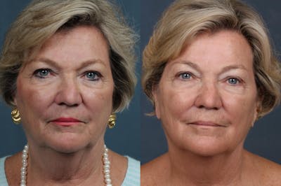 INFINI Before & After Gallery - Patient 279639 - Image 1