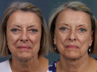 INFINI Before & After Gallery - Patient 161258 - Image 1