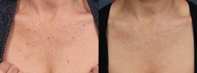 PICO Genesis Laser Treatment Before & After Gallery - Patient 275565 - Image 1