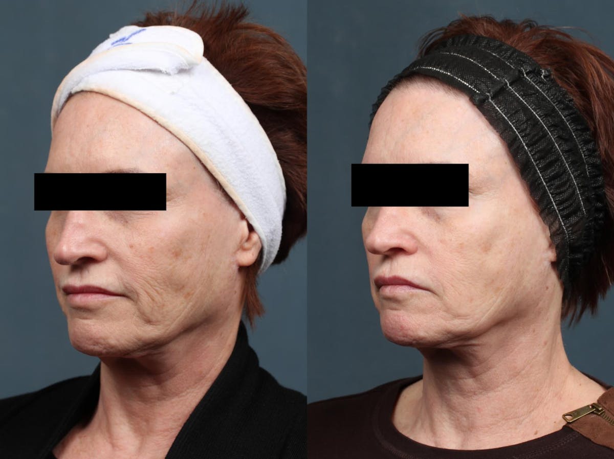 PICO Genesis Laser Treatment Before & After Gallery - Patient 321188 - Image 1