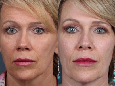 PICO Genesis Laser Treatment Before & After Gallery - Patient 415538 - Image 1