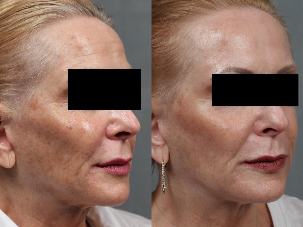 PICO Genesis Laser Treatment Before & After Gallery - Patient 311981 - Image 1