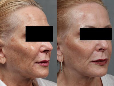 PICO Genesis Laser Treatment Before & After Gallery - Patient 311981 - Image 1