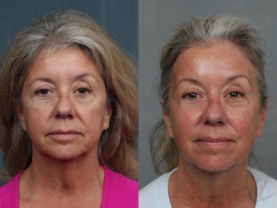 Ultherapy Before & After Gallery - Patient 370768 - Image 1