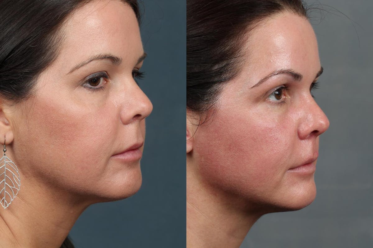 Ultherapy Before & After Gallery - Patient 118227 - Image 1