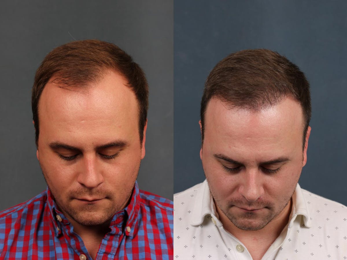 NeoGraft Hair Transplant Before & After Gallery - Patient 424420 - Image 1