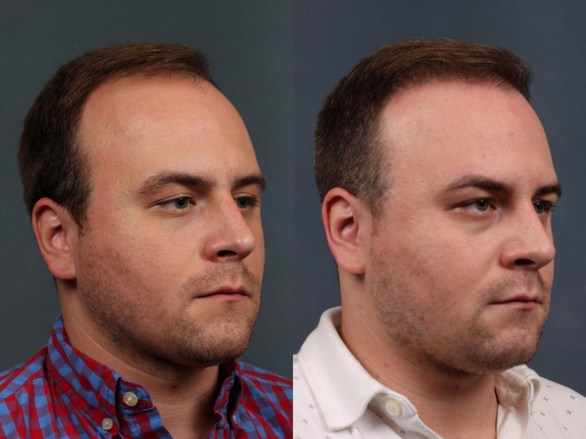 NeoGraft Hair Transplant Before & After Gallery - Patient 424420 - Image 2