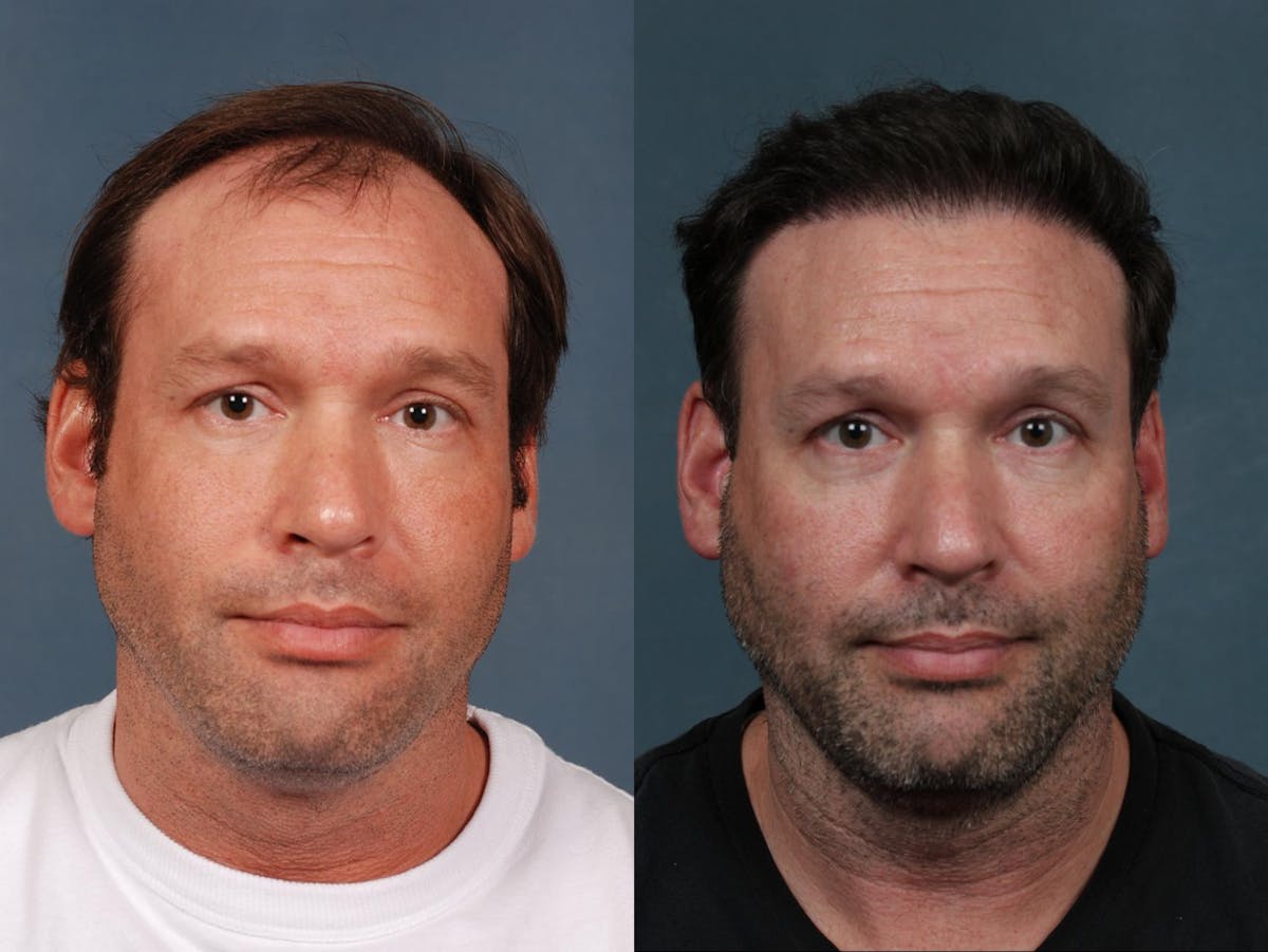 NeoGraft Hair Transplant Before & After Gallery - Patient 391976 - Image 1