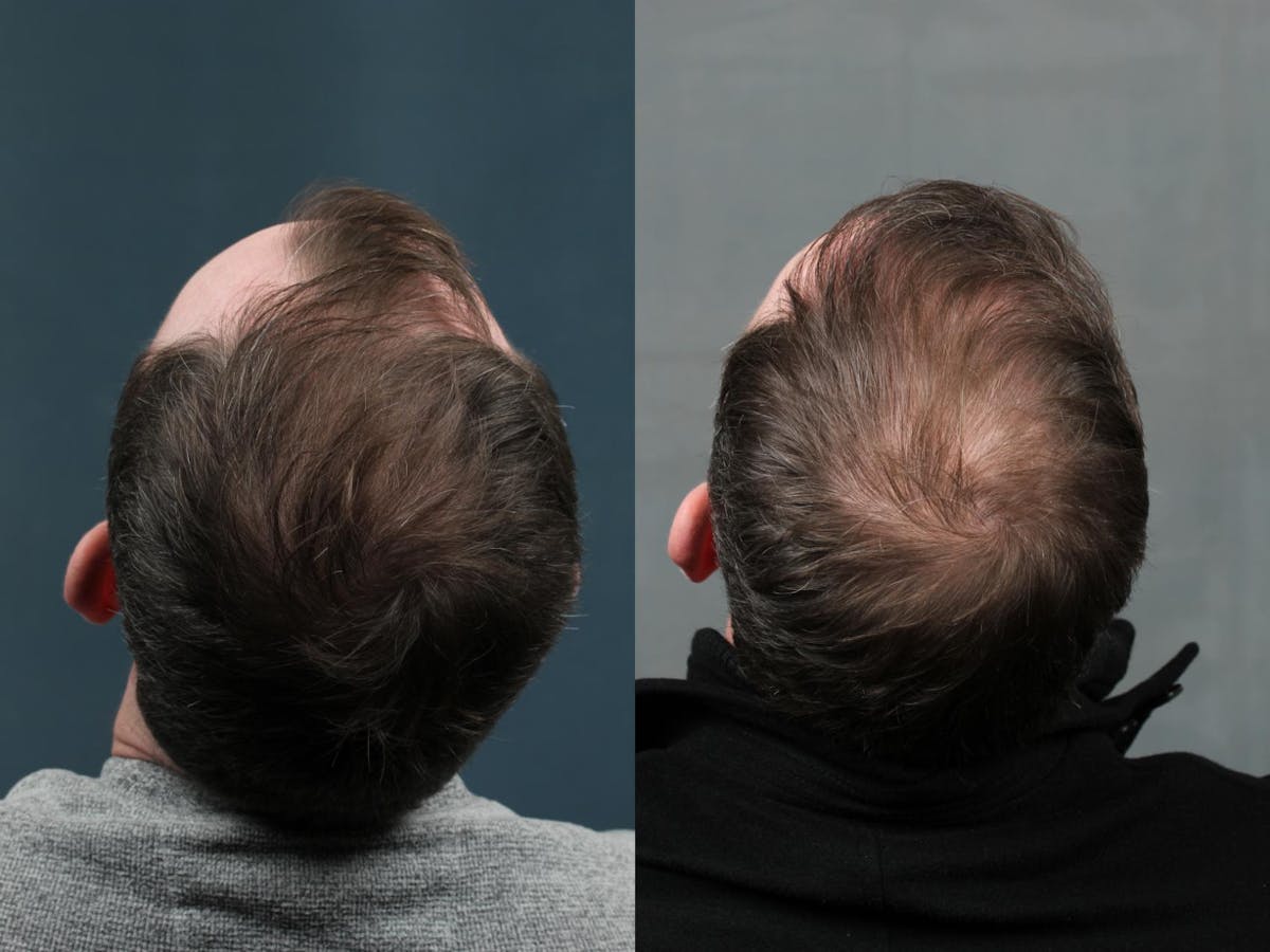 NeoGraft Hair Transplant Before & After Gallery - Patient 327511 - Image 2