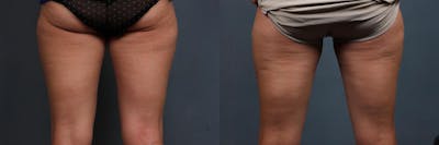 CoolSculpting Before & After Gallery - Patient 118778 - Image 1