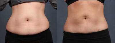 CoolSculpting Before & After Gallery - Patient 167582 - Image 1