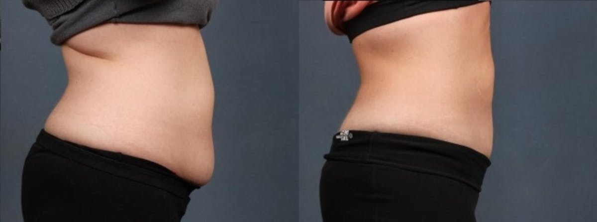 CoolSculpting Before & After Gallery - Patient 167582 - Image 2