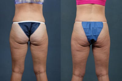 CoolSculpting Before & After Gallery - Patient 135818 - Image 1
