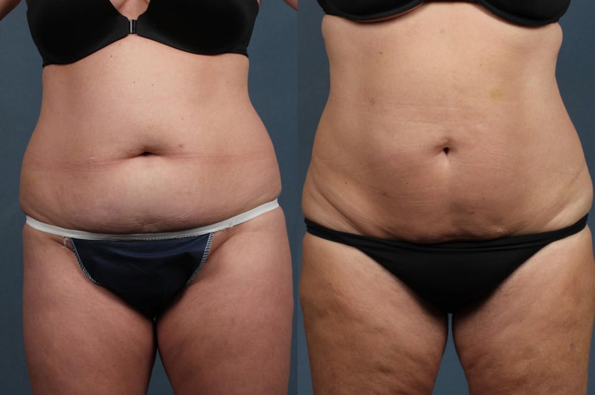 CoolSculpting Before & After Gallery - Patient 316067 - Image 1