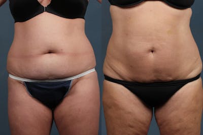 CoolSculpting Before & After Gallery - Patient 316067 - Image 1