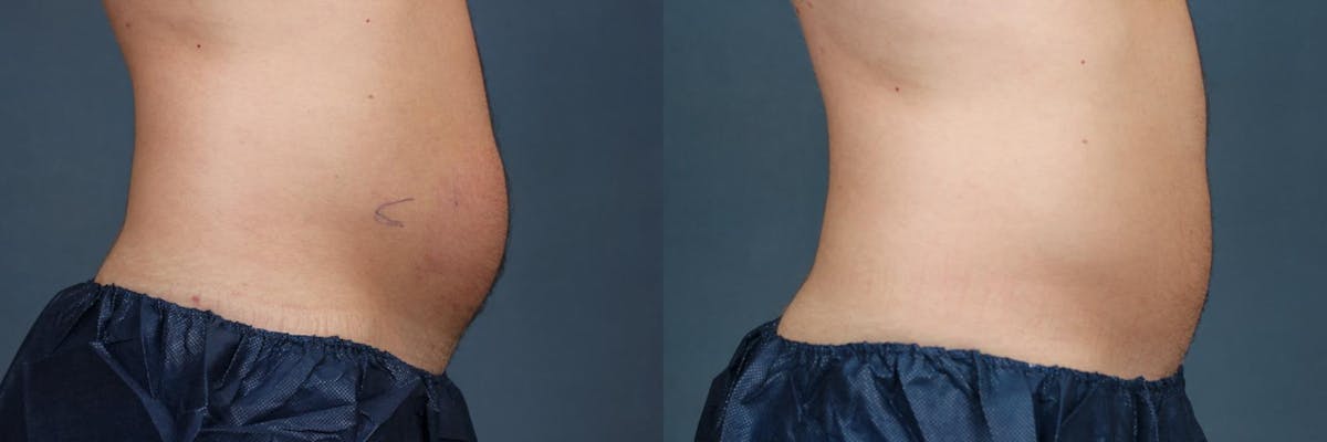 CoolSculpting Before & After Gallery - Patient 160556 - Image 1