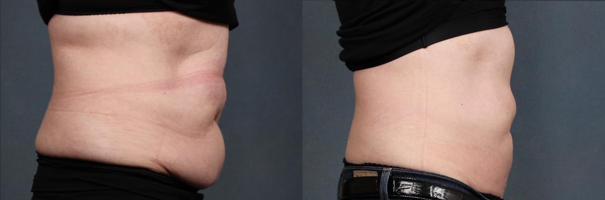 CoolSculpting Before & After Gallery - Patient 533947 - Image 2