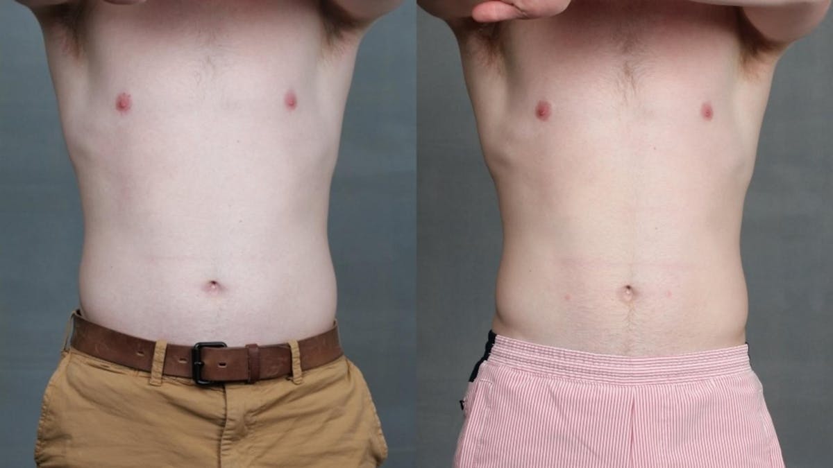 EMSculpt Before & After Gallery - Patient 336084 - Image 1