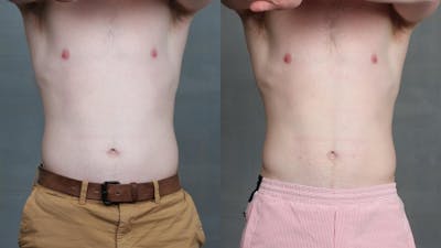 EMSculpt Before & After Gallery - Patient 336084 - Image 1