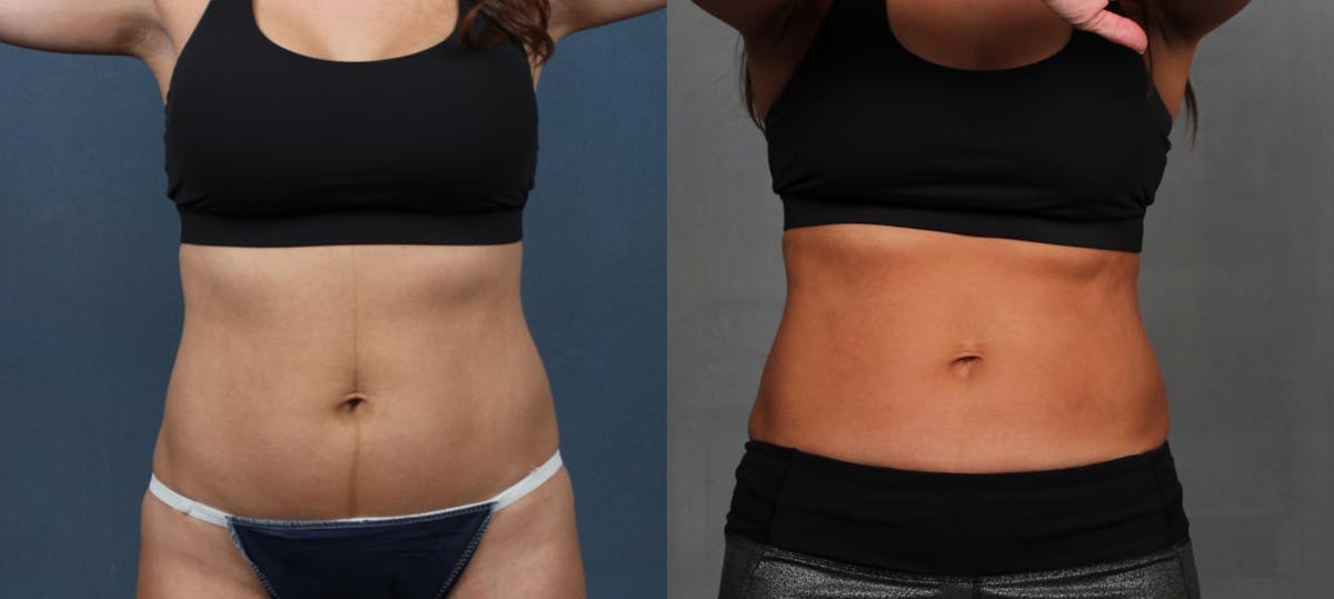 EMSculpt Before & After Gallery - Patient 115494 - Image 1