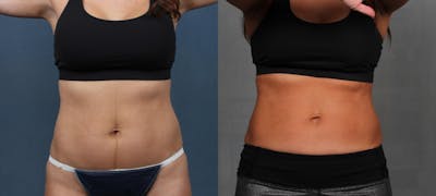 EMSculpt Before & After Gallery - Patient 115494 - Image 1