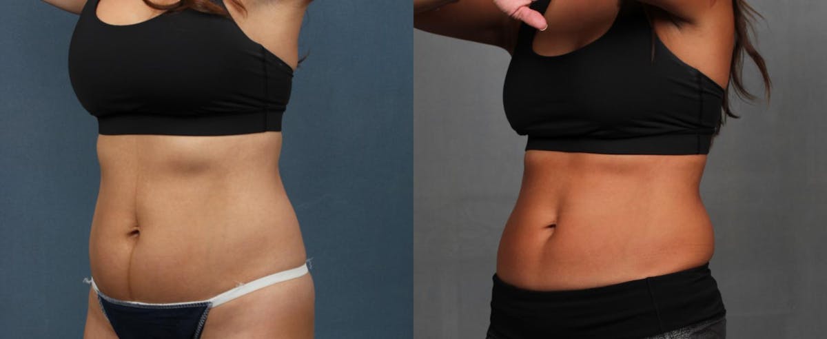 EMSculpt Before & After Gallery - Patient 115494 - Image 2